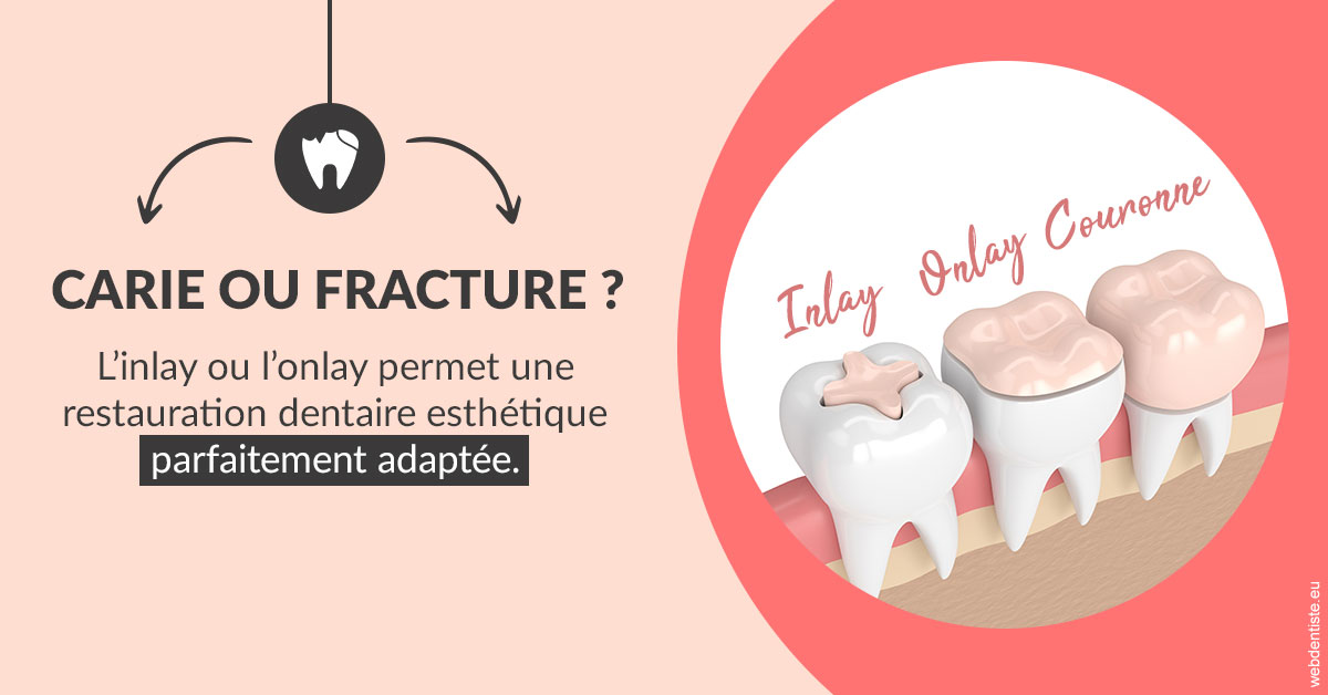 https://dr-boy-patrice.chirurgiens-dentistes.fr/T2 2023 - Carie ou fracture 2