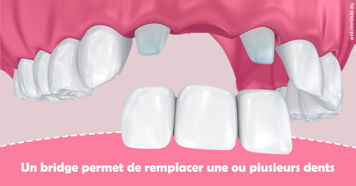 https://dr-boy-patrice.chirurgiens-dentistes.fr/Bridge remplacer dents 2