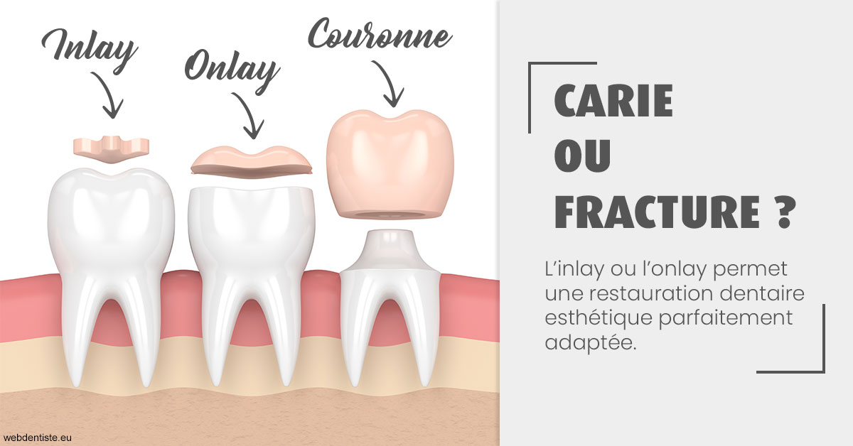 https://dr-boy-patrice.chirurgiens-dentistes.fr/T2 2023 - Carie ou fracture 1