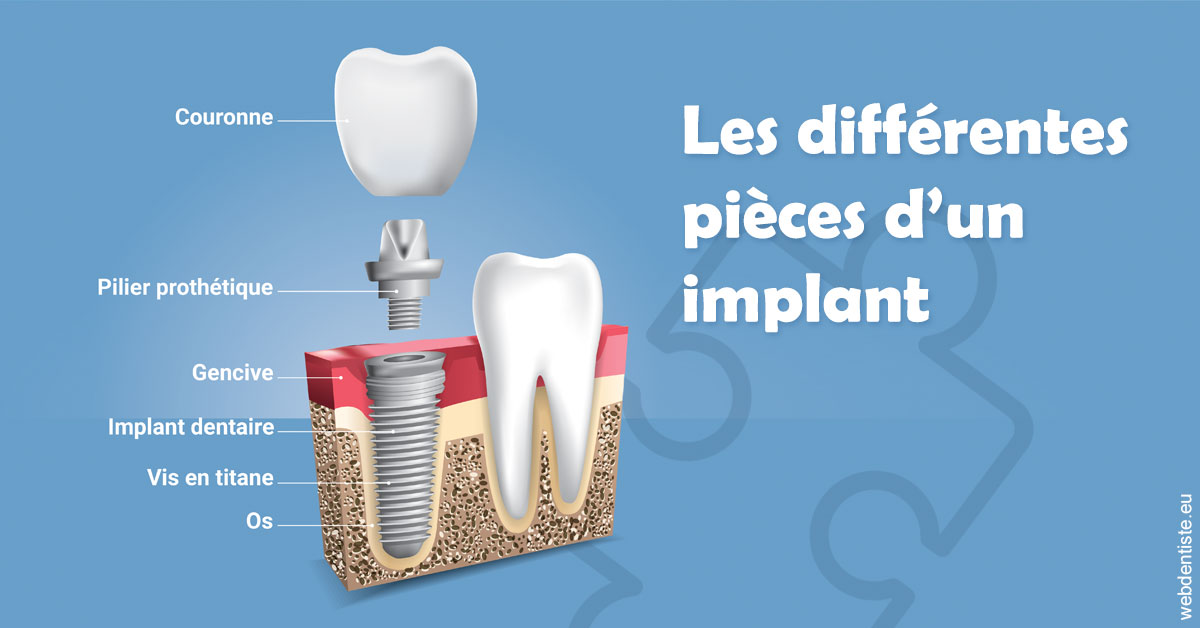 https://dr-boy-patrice.chirurgiens-dentistes.fr/Les différentes pièces d’un implant 1